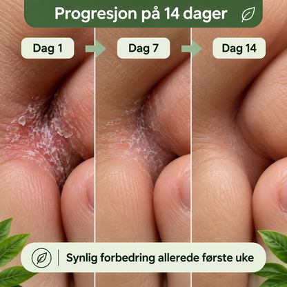 Astero™ Såpe mot Sopp